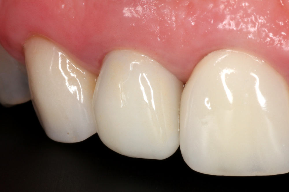 anterior implant case after