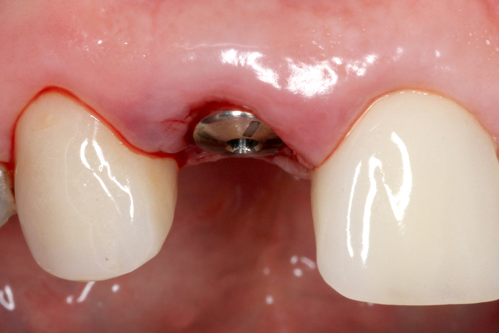 anterior implant case before