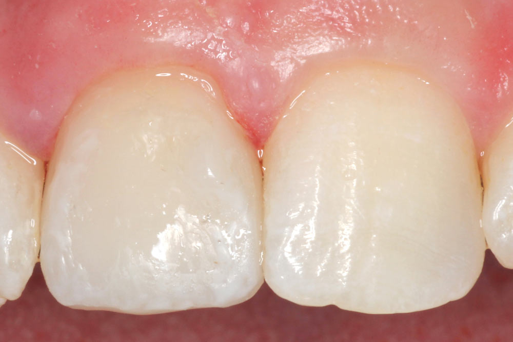 anterior single veneer - after