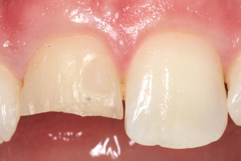 anterior single veneer before