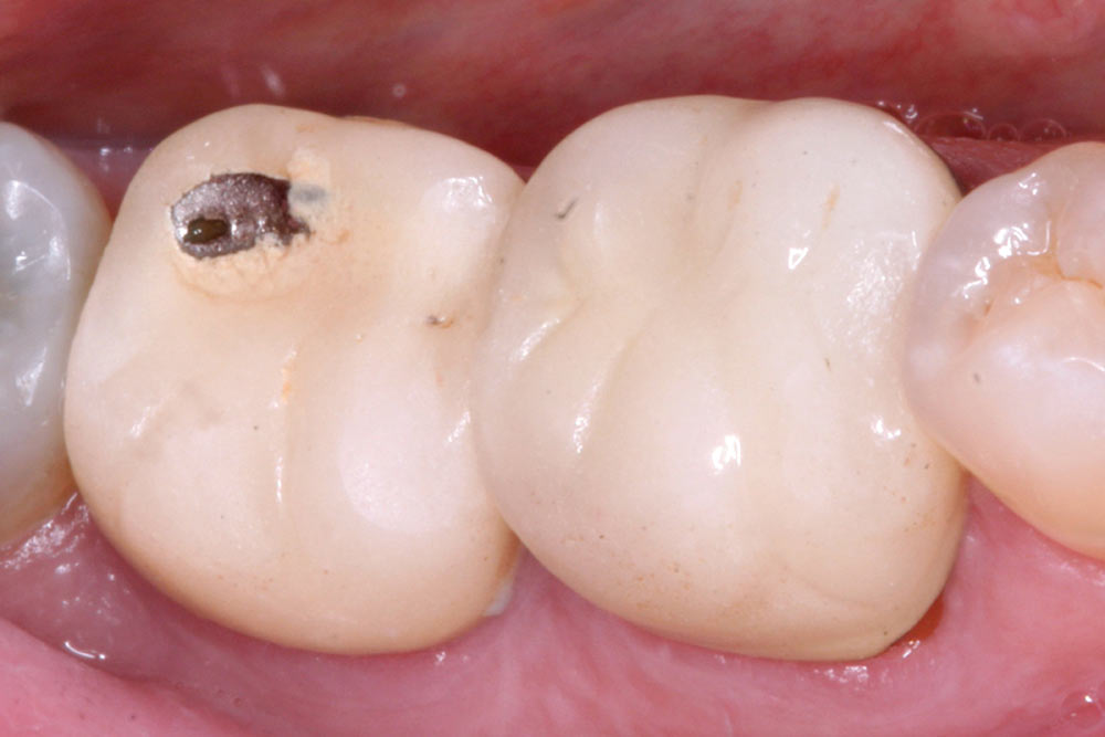 posterior quadrant before