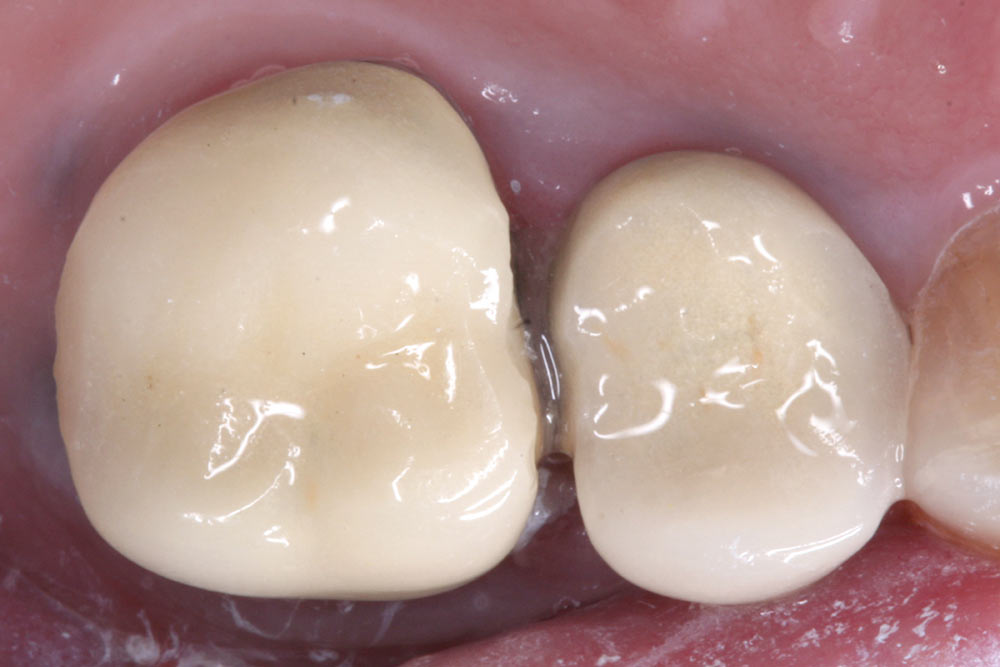 single posterior crown before