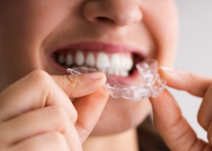 clear aligner therapy