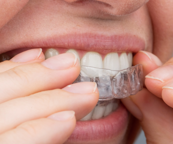 putting in a clear teeth aligner