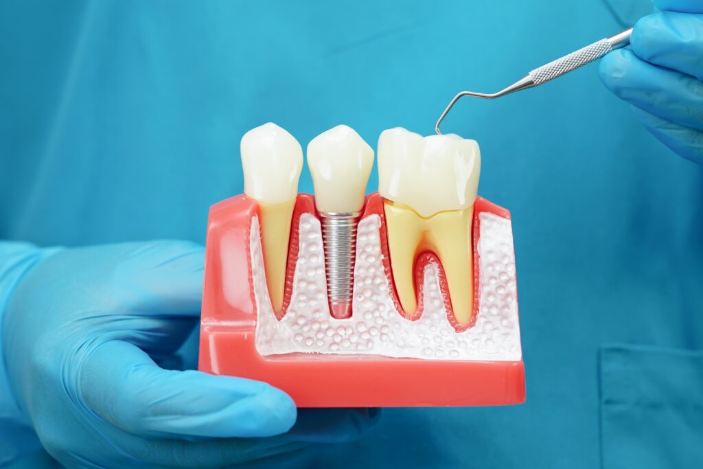 Dental Implants Wauwatosa
