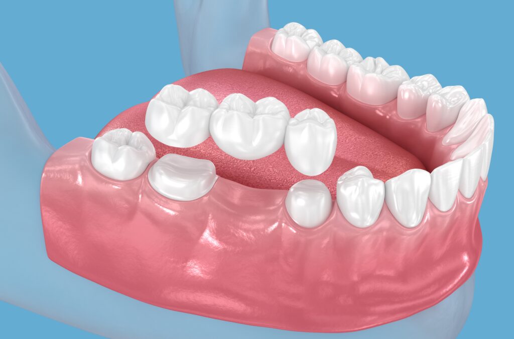 Dental Bridges Wauwatosa